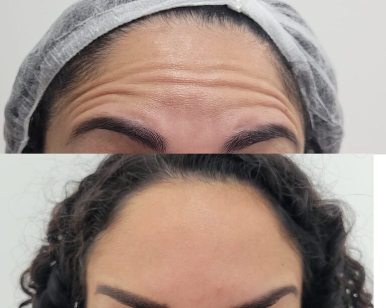 Botox preventivo.
