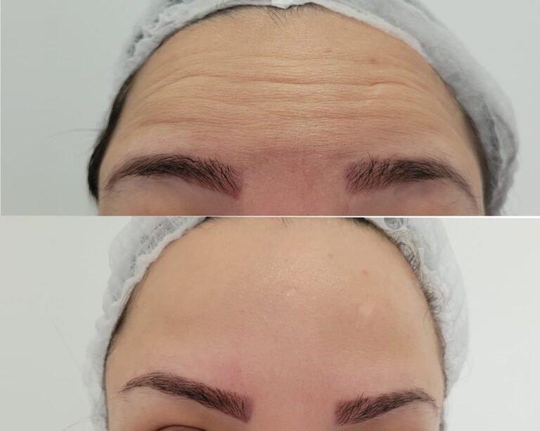Botox facial.