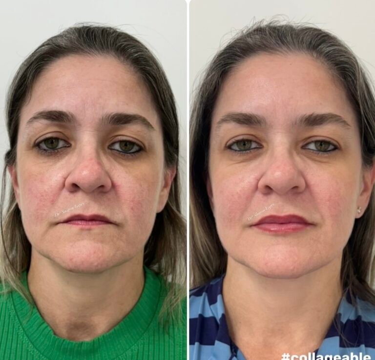 Rejuvenescimento