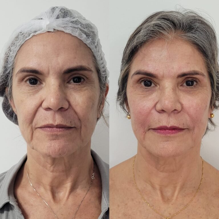 Rejuvenescimento