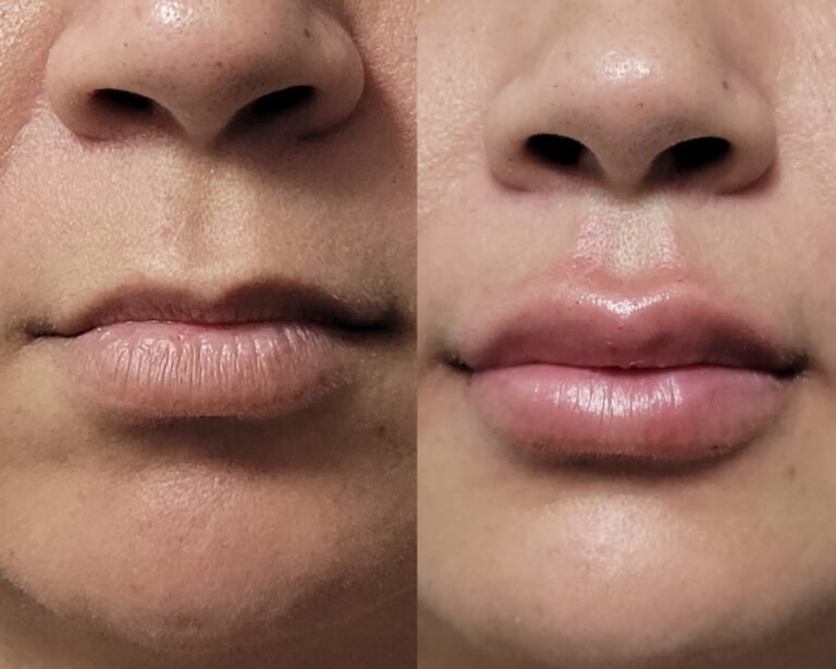 Preenchimento labial